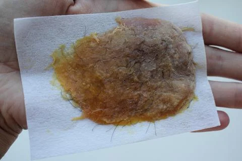 Epilation of the bikini area. Close-up of liquid wax hair removal. Shugaring Stock Photos