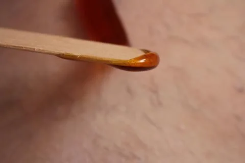 Epilation of the bikini area. Close-up of liquid wax hair removal. Shugaring Stock Photos
