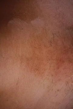 Epilation of the bikini area. Close-up of liquid wax hair removal. Shugaring Stock Photos