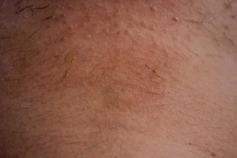 Epilation of the bikini area. Close-up of liquid wax hair removal. Shugaring Stock Photos