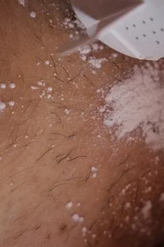 Epilation of the bikini area. Close-up of liquid wax hair removal. Shugaring Stock Photos