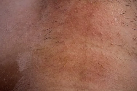 Epilation of the bikini area. Close-up of liquid wax hair removal. Shugaring Stock Photos