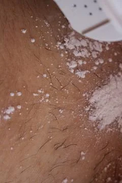 Epilation of the bikini area. Close-up of liquid wax hair removal. Shugaring Stock Photos