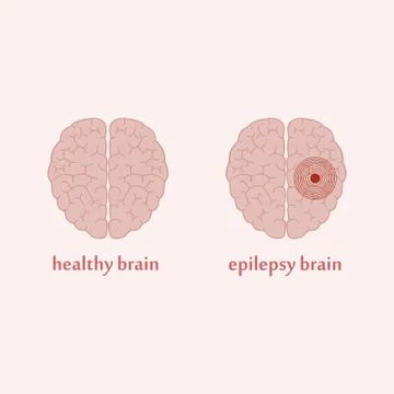 Epilepsy brain Stock Illustration