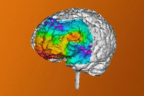  Epilepsy, mri A 3D reconstruction of the brain obtained from magnetic res... Stock Photos