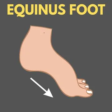 EQUINUS FOOT - 1 Stock Illustration