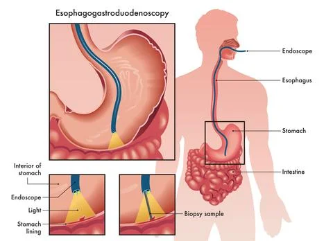 Esophagogastroduodenoscopy Stock Illustration