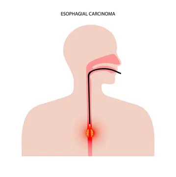 Esophagus endoscopy procedure Stock Illustration