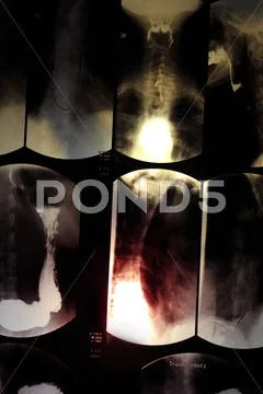 Esophagus x-ray Stock Photos