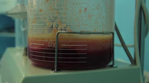 Evacuated for liposuction fat 스톡 동영상 67218125