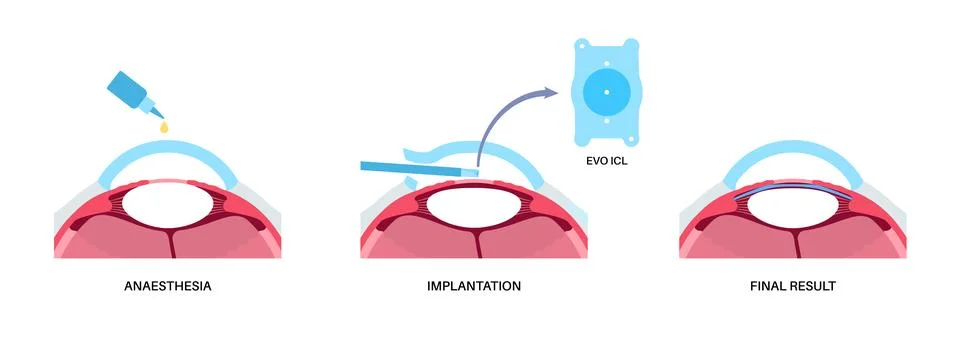 EVO ICL poster Stock Illustration
