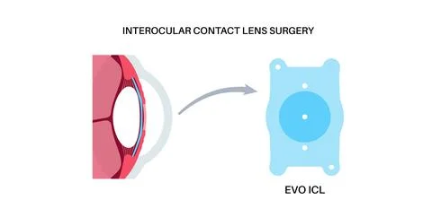 EVO ICL poster Stock Illustration