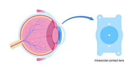 EVO ICL poster Illustrazione stock