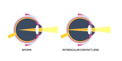 EVO ICL poster Illustrazione stock