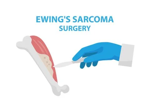 Ewing s sarcoma surgery vector illustration isolated on white background in flat Stock Illustration