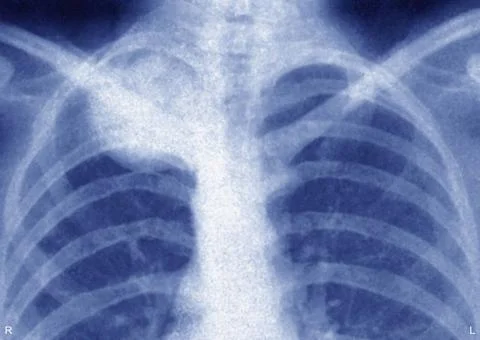  Ewing s sarcoma, x-ray Ewing s sarcoma at the level of the thorax, on the... Stock Photos