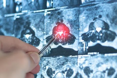 Examination mri of inside herniated vertebral disk in spine, close up x-ray.. Stock Photos