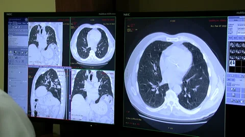 Examination of MRI or CT scan images of human brain on computer screen 動画素材 32675200