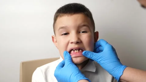 Examination of the oral cavity of a boy with missing milk teeth. Dentistry an Stock Footage 265589549