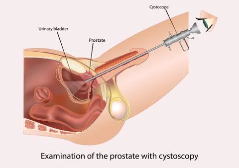 Examination of the prostate with cystoscopy Stock Illustration