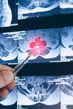 Examination vertical mri of inside herniated vertebral disk in spine, close.. Фото