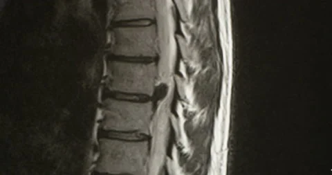 Examining an MRI Scan of Lumbar Spines of a Patient with Chronic Back Pain Video stock 145480054