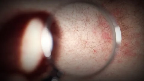 Examining red pimples on human skin under the magnifying glass, skin rashes and Stock Footage 303663044