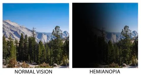 Example of vision with Hemianopsia 写真素材