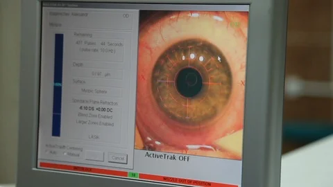 Excimer laser vision correction. corneal cutting of the eye. Stock Footage 113782582