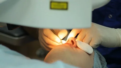 Excimer laser vision correction. work of a surgeon. Stock Footage 113781568