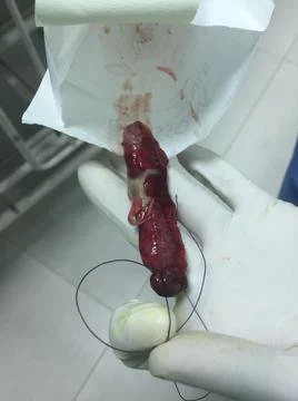 Excised Appendix Specimen Held in a Gloved Hand After Appendectomy Stock Photos