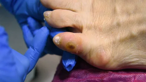 Excision of calluses on the toe with a pedicure machine Stock Footage 100471804