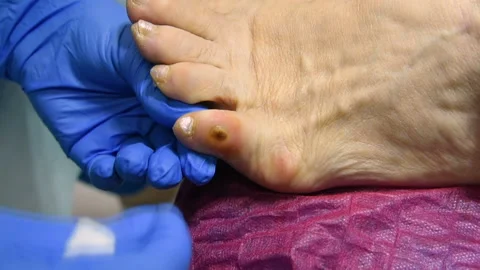 Excision of calluses on the toe with a pedicure machine Video stock 102909658