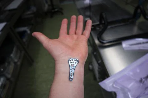 An explanted surgical blue titanium radius plate lies on the wrist Stock Photos