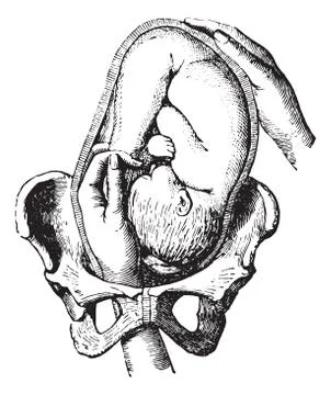 External cephalic version, vintage engraving. Stock Illustration