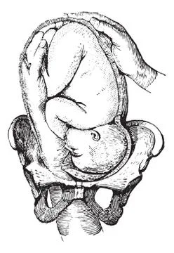 External cephalic version, vintage engraving. Stock Illustration