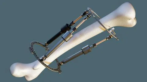 An external fixator apparatus attached to a simplified model of a long bone. Stock Illustration