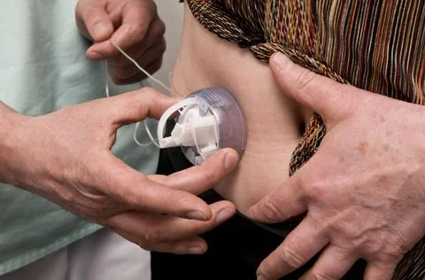  External insulin pump Consultation of functional insulin therapy, for a 5... 库存照片