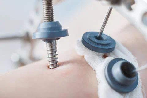 External ring fixation technique Ilizarov, in orthopedic medicine. Close up Stock Photos