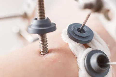 External ring fixation technique Ilizarov, in orthopedic medicine. Close up Stock Photos