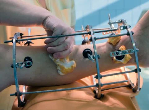 External ring fixation technique in orthopedic medicine Stock Photos