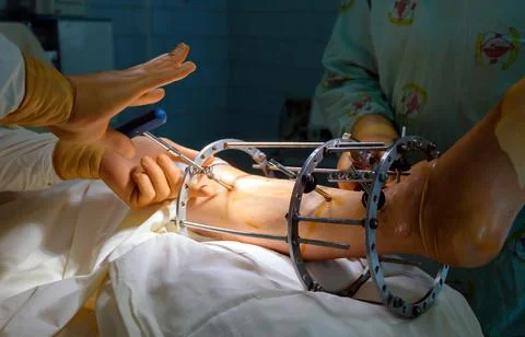 External ring fixation technique in orthopedic medicine Stock Photos