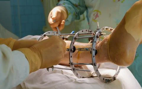 External ring fixation technique in orthopedic medicine Stock Photos