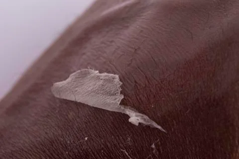 External skin layer exfoliation process, dry epidermis close up Stock-Fotos