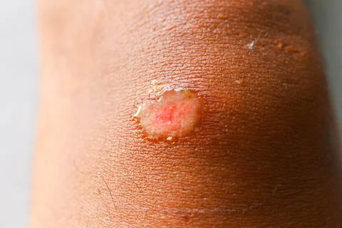 External Wounds 1 Stock Photos