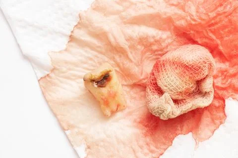 An extracted tooth with a black hole in the middle of the tooth, close-up aga Stock Photos