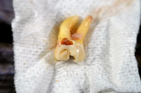 Extracted wisdom 8th lower right tooth with a teeth decay, after exposed ne.. Foto stock