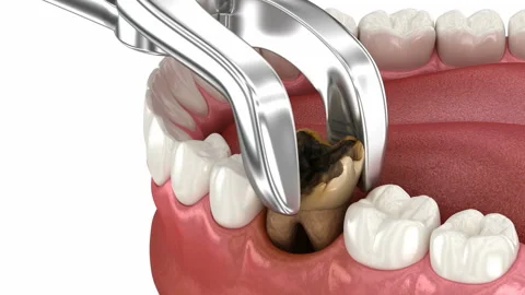 Extraction of damaged tooth. Stock Footage 236101351