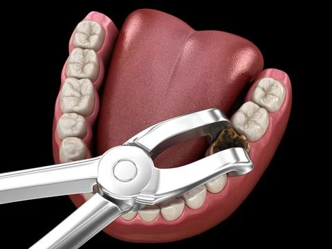 Extraction of Molar tooth damaged by caries. Medically accurate tooth 3D illu Stock Illustration