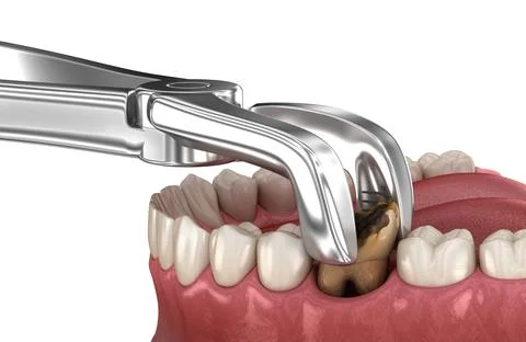 Extraction of Molar tooth damaged by caries. Medically accurate tooth 3D illu Stock Illustration